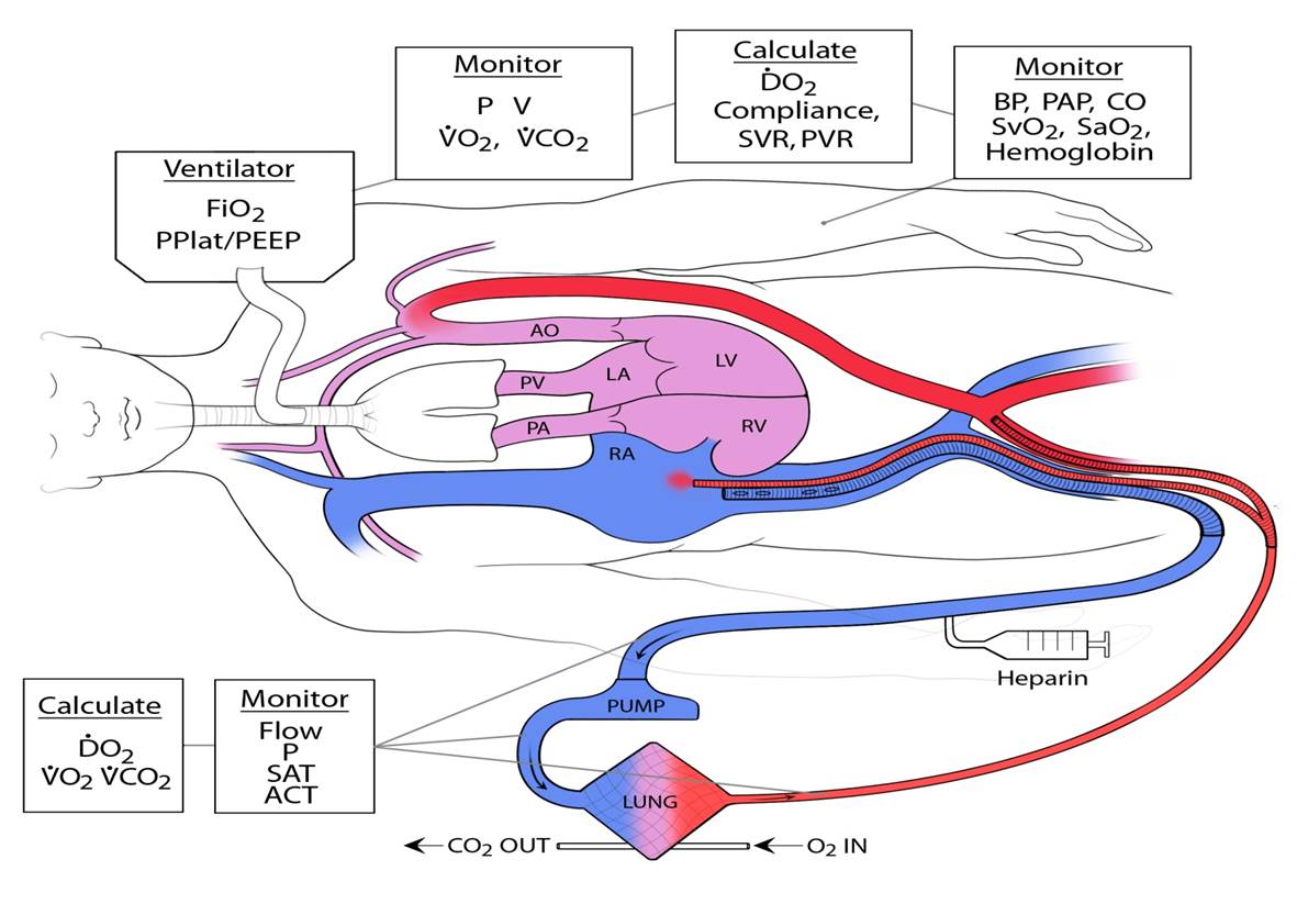 schematic of the extracorporeal membrane oxygenation, or ECMO, technology